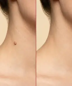 Cpviat™ ClearTag Microneedle Skin Tag Patch