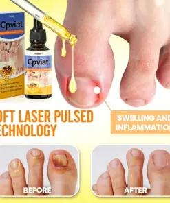 Cpviat Bee Venom Toenail Fungus Treatment for Thick Cracked Yellow Nails